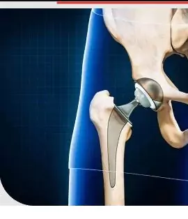 Hip Replacement Surgery